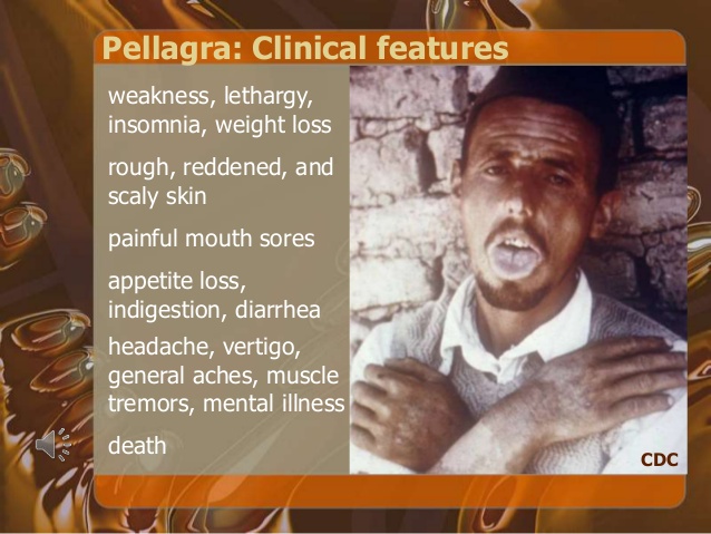 information about pellagra